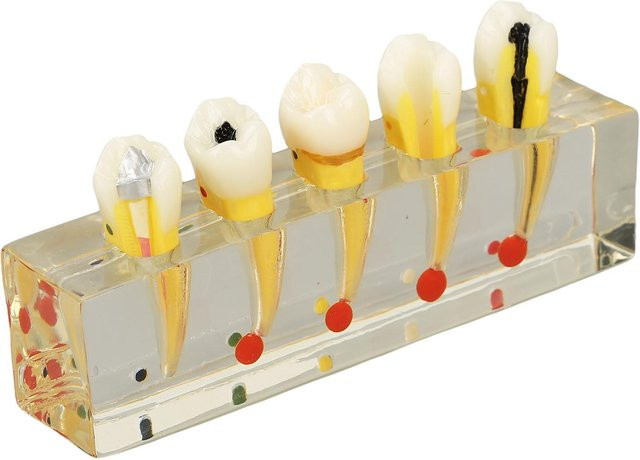 AROMA Zahnmodell Dentalstudium, Transparentes Implantat Zahnkariesmodell, beige - Bild 1
