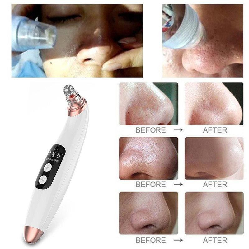 Vakuum Gesichtsreinigungs- und Peelinggerät mit 6 Aufsätzen und USB-Ladefunktion in Weiß - Bild 2