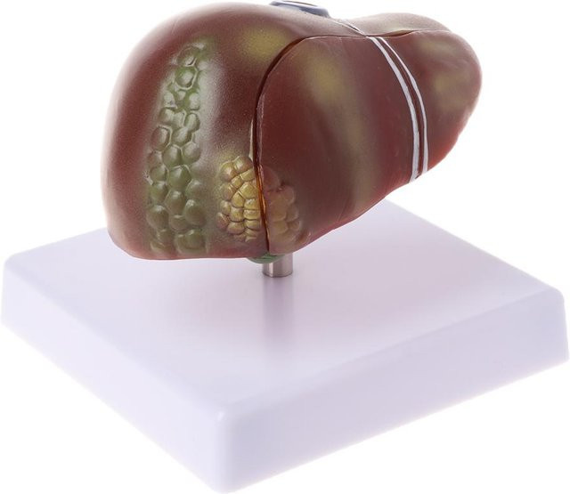 Argon Menschliche Leber, Anatomisches Modell, Pathologisches Modell - Bild 1