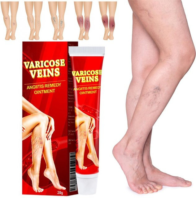 Venoheal Paste zur Linderung von Krampfadern und Besenreisern - Bild 1