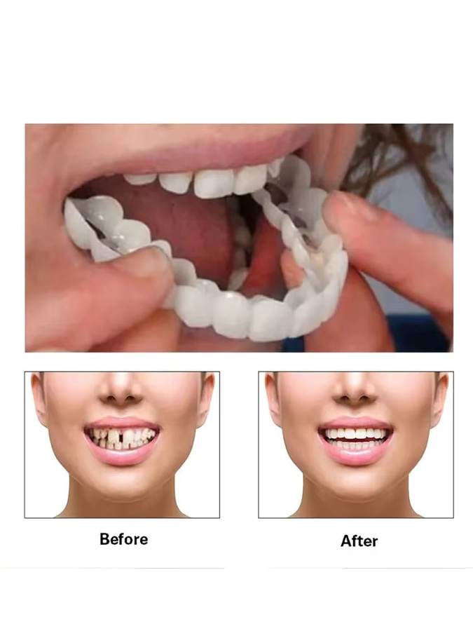 Dentsmile Beauty Veneer Kit, Unisex, 8 Sets - Bild 5