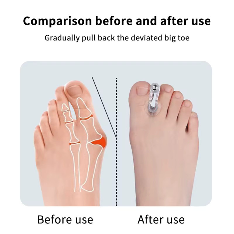 eelhoe Hallux-Valgus-Korrektor, Zehenspreizer, Unisex - Bild 3
