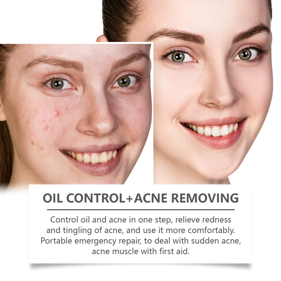 ZYVARN Akne-Reparatur Trocknungslotion, 30 ml, Unreine Haut - Bild 3