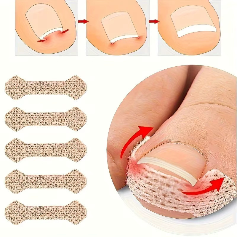 CNKESS Zehennagel Korrekturstreifen, 5 Stück, Unisex, für Füße - Bild 2