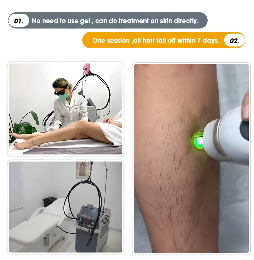 SLyric Clinic Alexandrite-Maschine zur Haarentfernung und Hautverjüngung - Bild 5