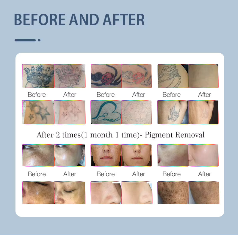 TAIXL Pico-Laser Nd:YAG Q-Switched Tattoo-Entfernungsmaschine, Unisex, weiß - Bild 6