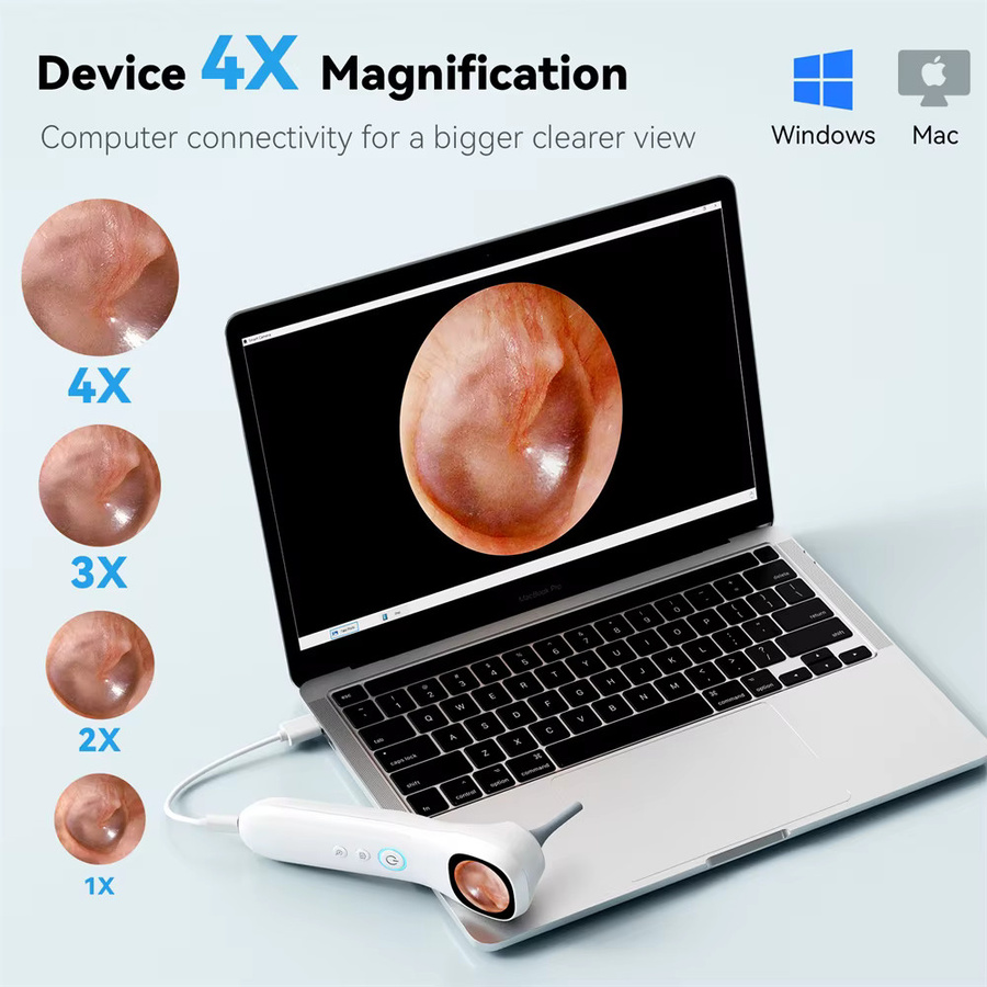 INSKAM 5-in-1 Smart Detektor mit 1080P HD-Ohrkamera und Bildschirm in Weiß inklusive Ohrstöpsel-Set, sechs Ersatzspitzen und zwölf zusätzlichen Inspektionsköpfen - Bild 6