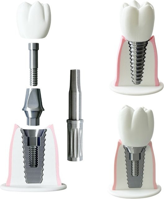 YOUYA DENTAL Zahnimplantat-Anatomie-Lehrmodell, mit abnehmbarer Krone und Brückenrestauration - Bild 1