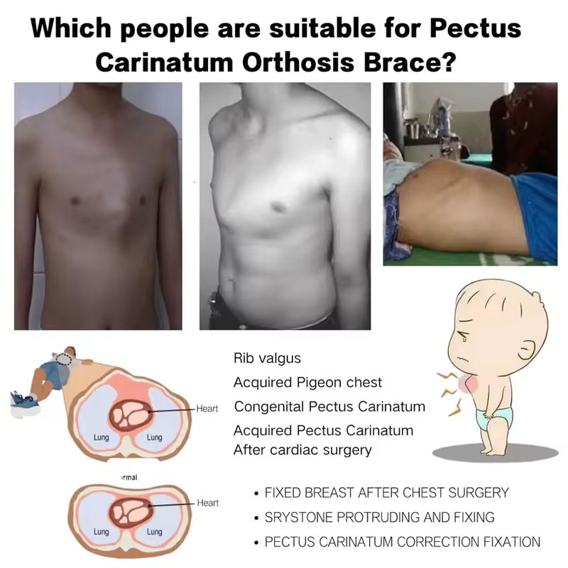 FODRK Pectus Carinatum-Orthese, Unisex - Bild 3
