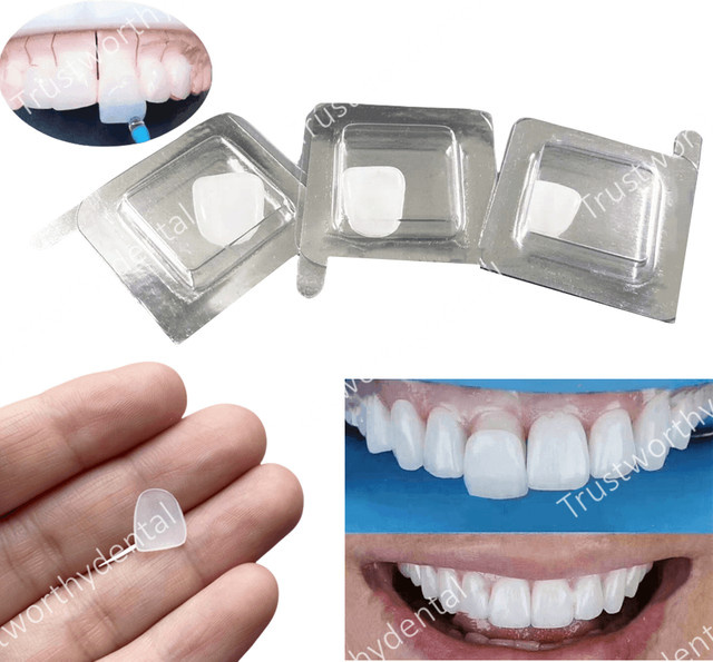 ACMEDENT Dental Composite Porzellan Veneer, Helle Weiße Zahnmedizin Restaurierung - Bild 1