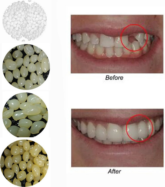 eelhoe Zahnersatz-Veneers mit Klebeperlen, 4 Farben - Bild 1