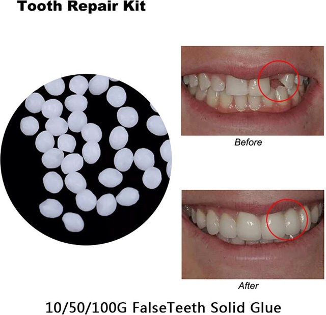 HNKMP Dental Harz, Formbare Zähne Kleber, Temporäre Füllung, Reparaturmaterial - Bild 1