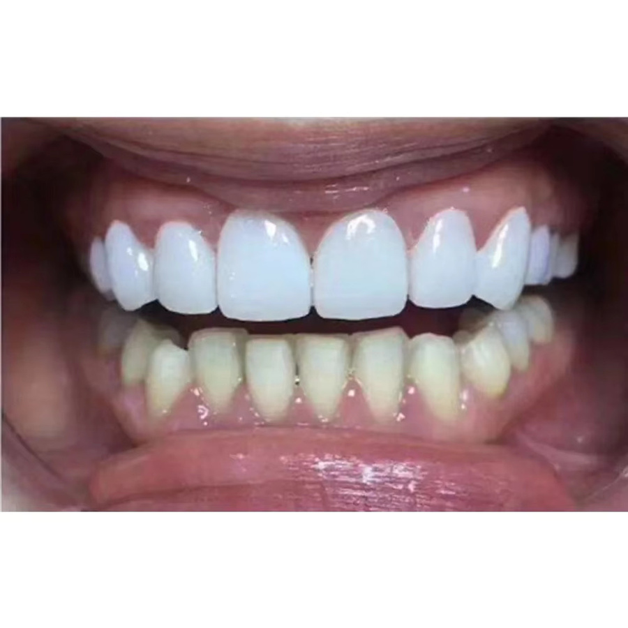 SowSmile Snap-on Smile Veneers zur Zahnlücken-Reparatur - Bild 4