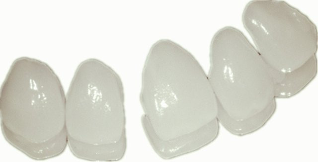 SowSmile Snap-on Smile Veneers zur Zahnlücken-Reparatur - Bild 1
