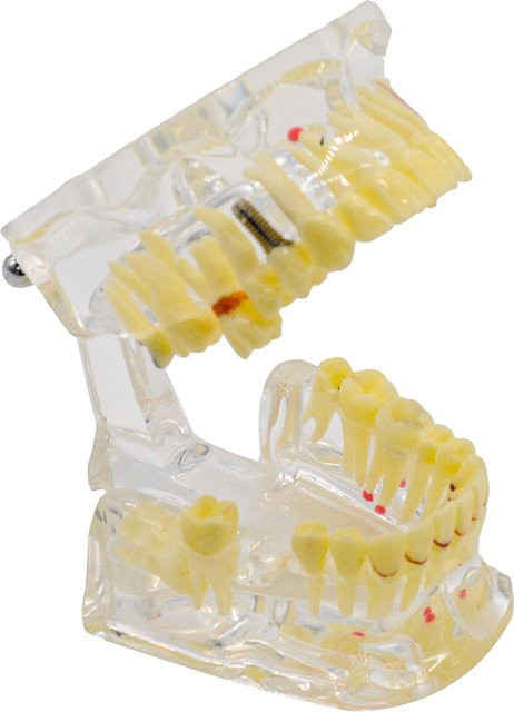 CHIHIRO CARE Dental Zähne Modell Implantat, Dental Bildung Modell, 1-teiliges Set - Bild 1