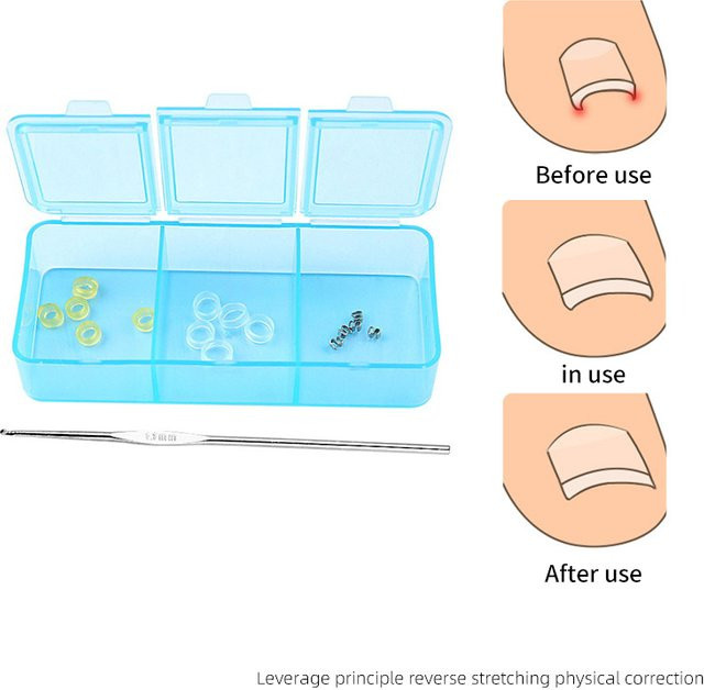 KuZHEN Zehennagel Corrector Pediküre Patch, Fuß Korrektur Werkzeug - Bild 1