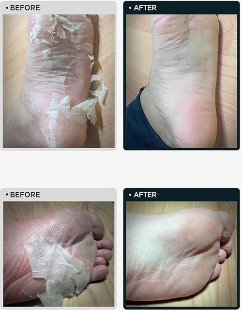 TOSOWOONG Fußpeeling Maske, 2 Stück, Unisex - Bild 1