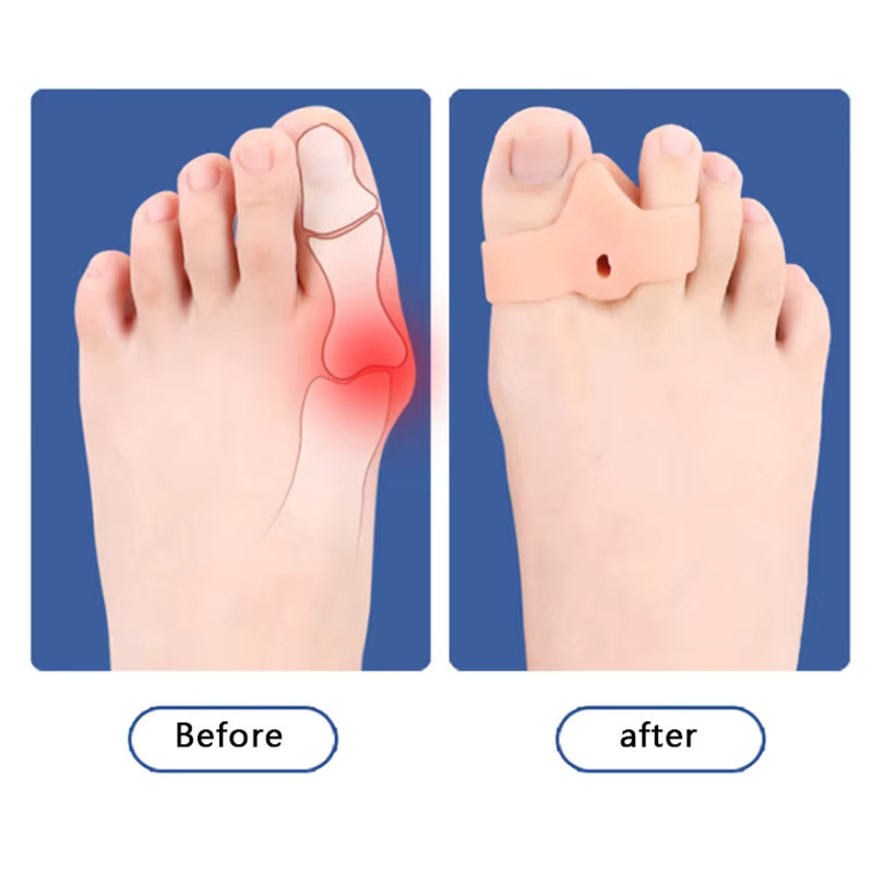 HNKMP Hallux Valgus Protector Silikon Gel Daumen Korrektor, 2 Stück, Nude - Bild 2