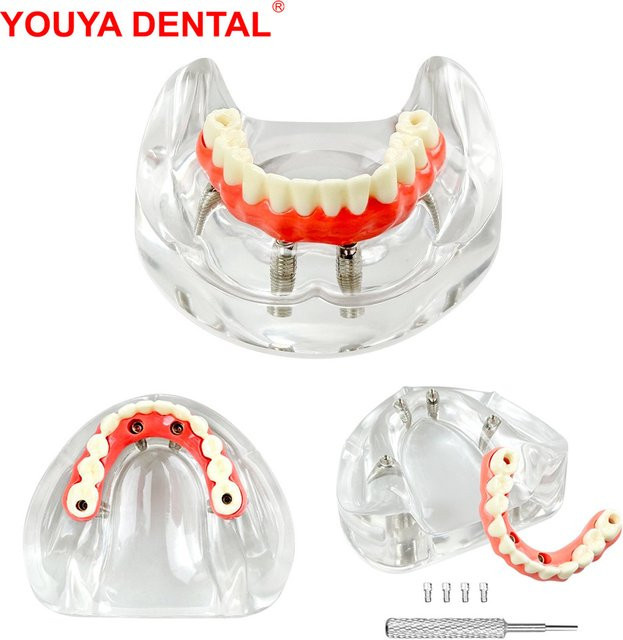 YOUYA DENTAL Zahnimplantatmodell, 4 Implantate, Maryland-Brückenzahnmodelle, Overdenture-Restaurierung, Typodont - Bild 1