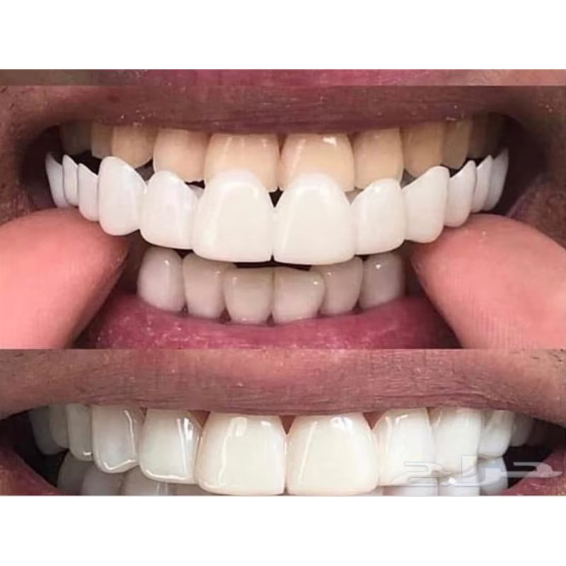 Pop Dental Snap Smile Zahnprothesen für den Oberen Kiefer, Flexible Veneers - Bild 4